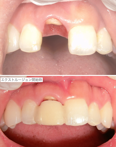 エクストルージョン