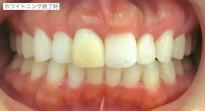 ホームホワイトニング