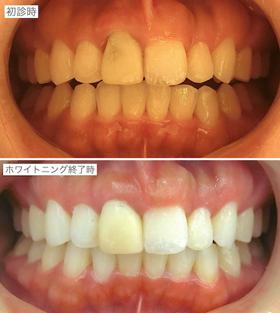 ホワイトニング前後