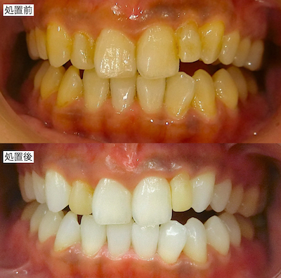 ホームホワイトニング