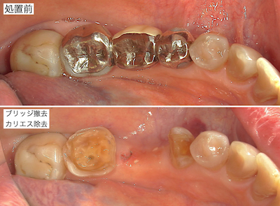 ブリッジ除去時