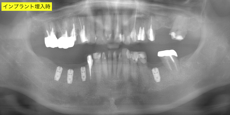 インプラント埋入後