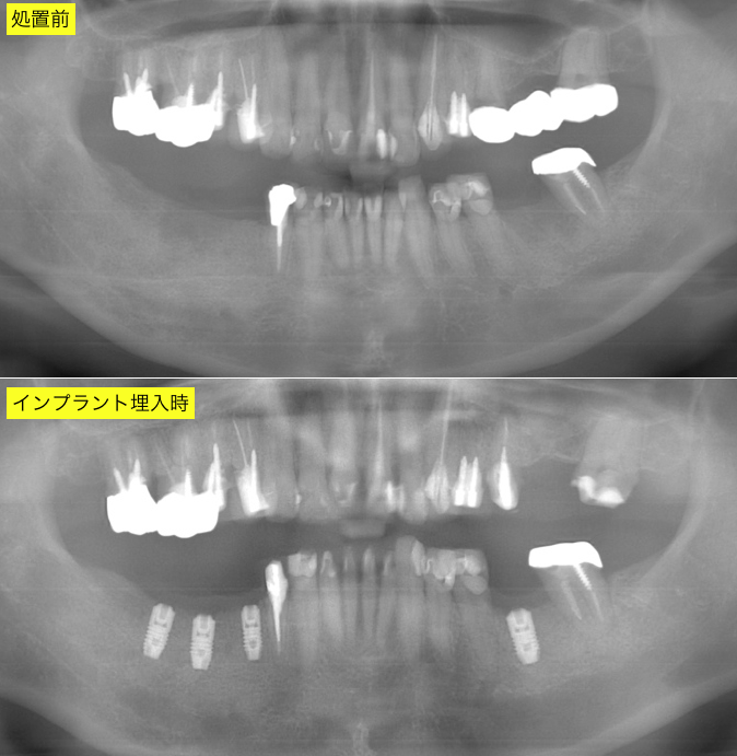 インプラント術前術後