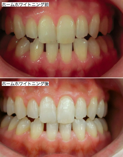 ホームホワイトニングBA