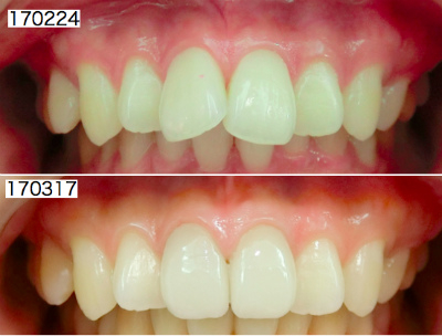 前歯部審美治療