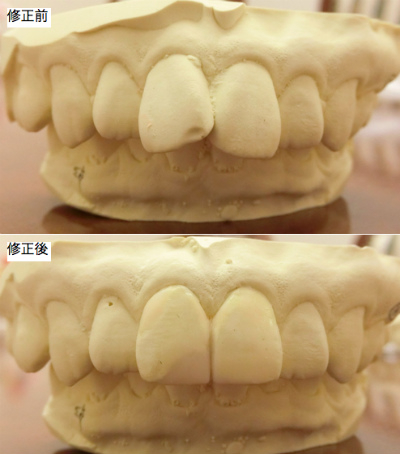 前歯部審美治療