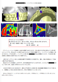 インプラント