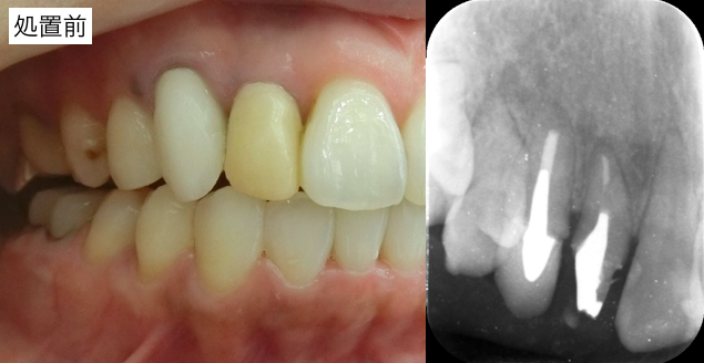 前歯部レントゲン