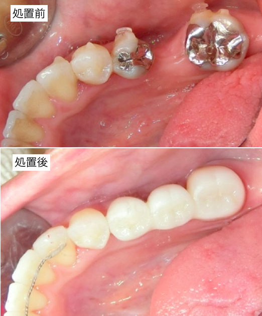 臼歯部審美治療