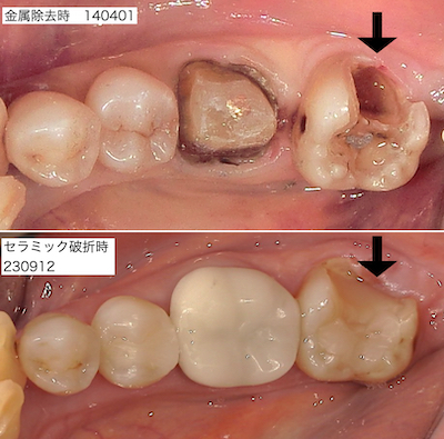金属除去時