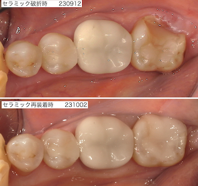 再セラミック治療