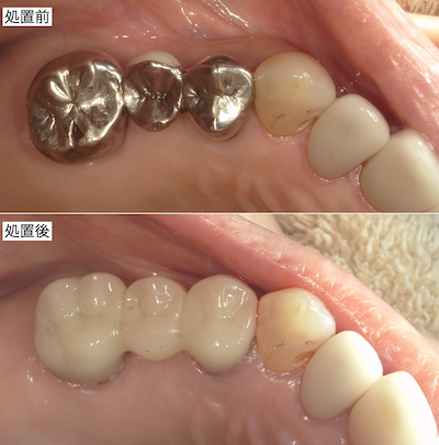 セラミック治療