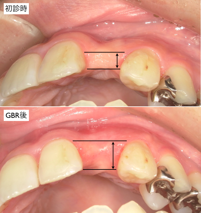 GBR前後