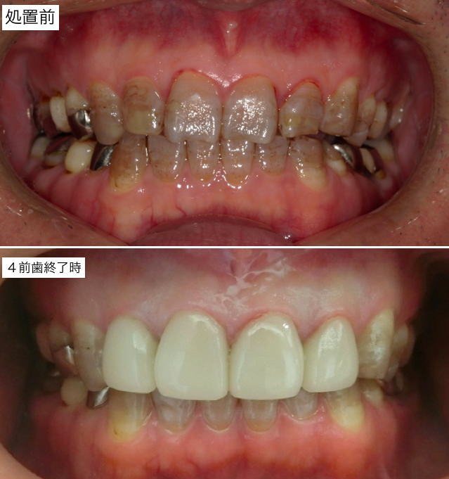 ４前歯処置後