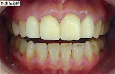 仮歯