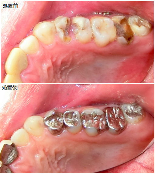 全体的なむし歯治療