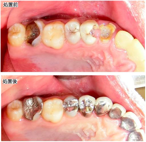 全体的なむし歯治療