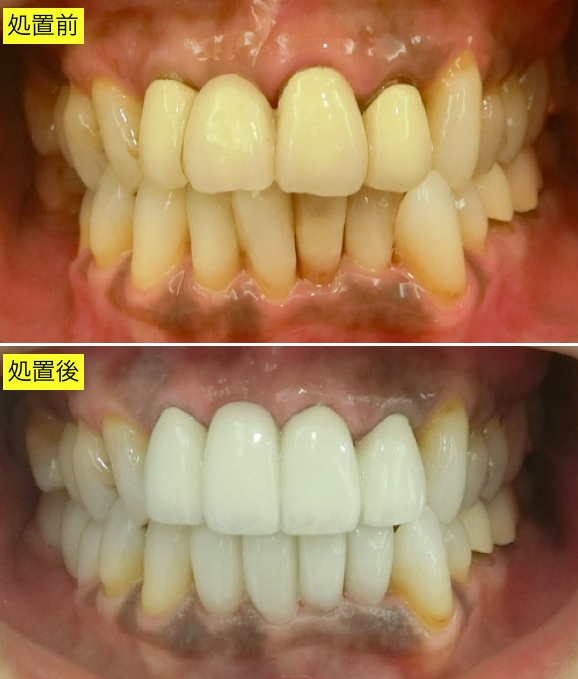 前歯部審美治療