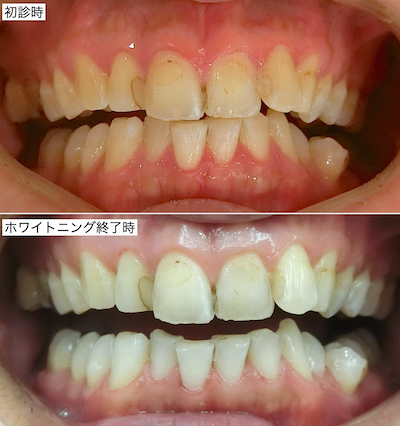 ホームホワイトニング