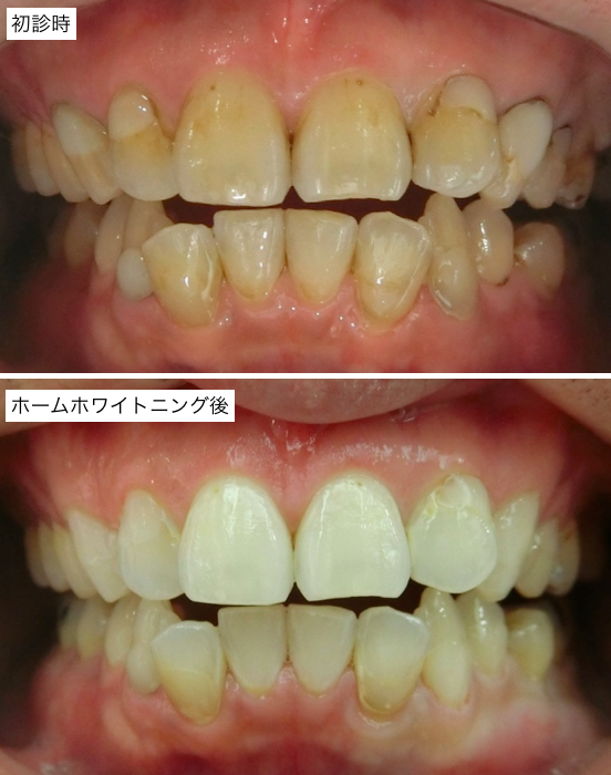 ホームホワイトニング