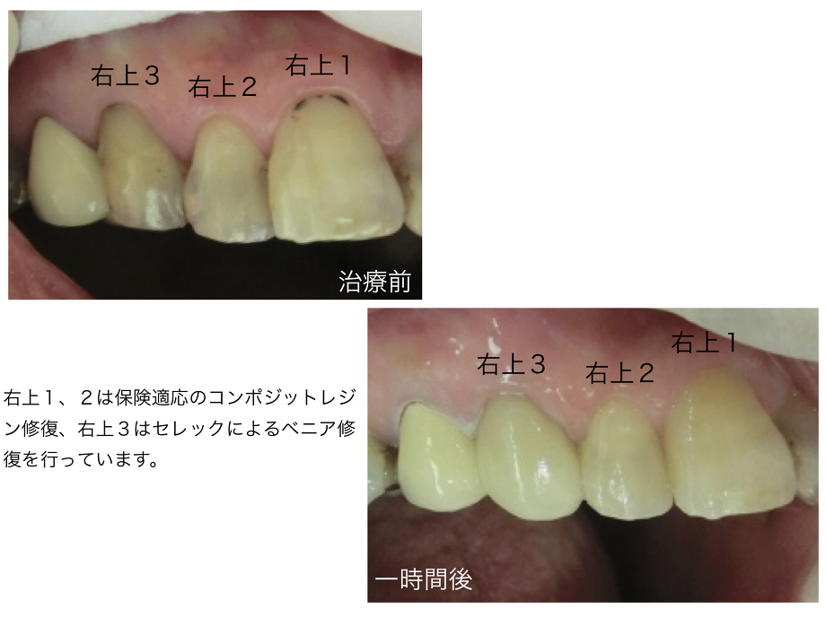 審美修復治療。